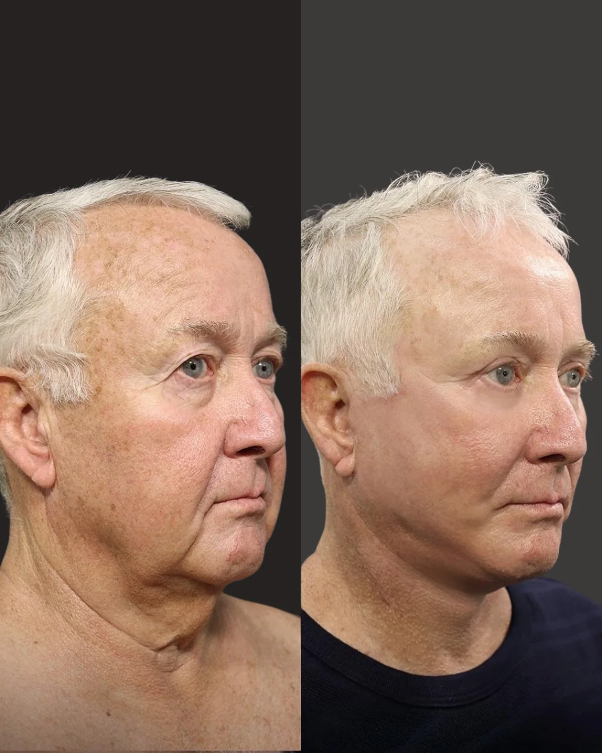 A male patient before and after a face and neck lift by Dr. Quiroz