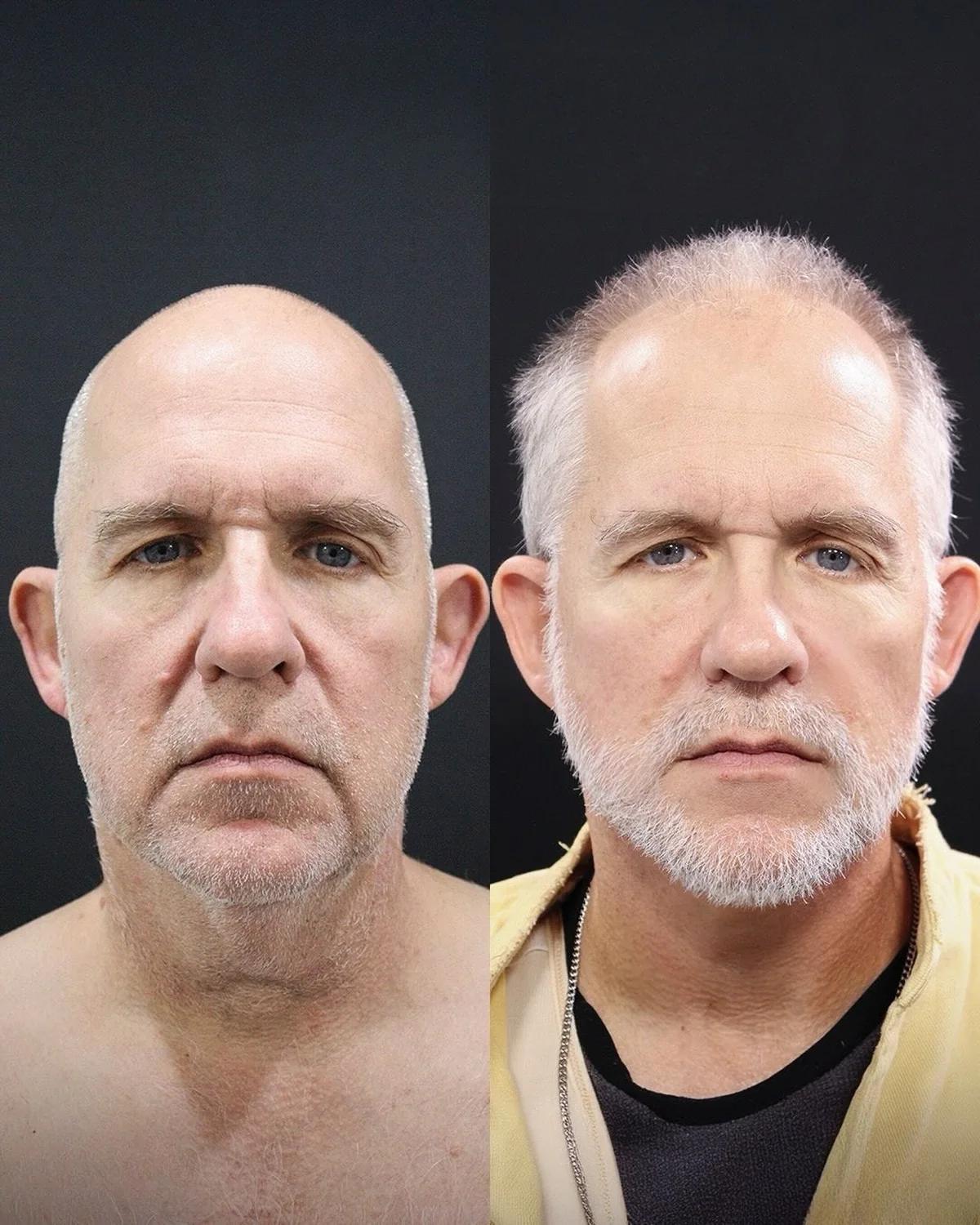 A male patient before and after a lower face and neck lift by Dr. Quiroz
