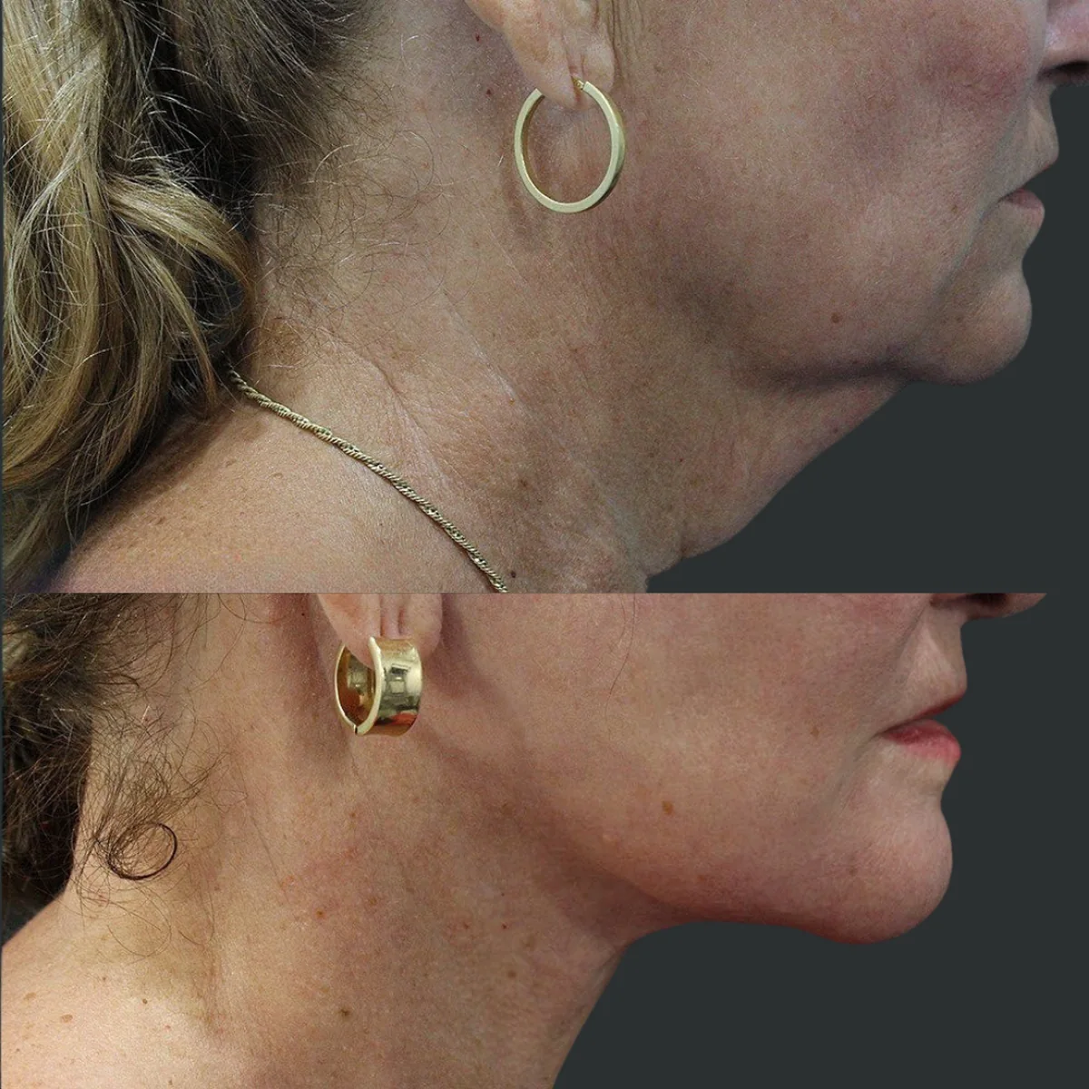 A patient before and after a neck lift by Dr. Quiroz