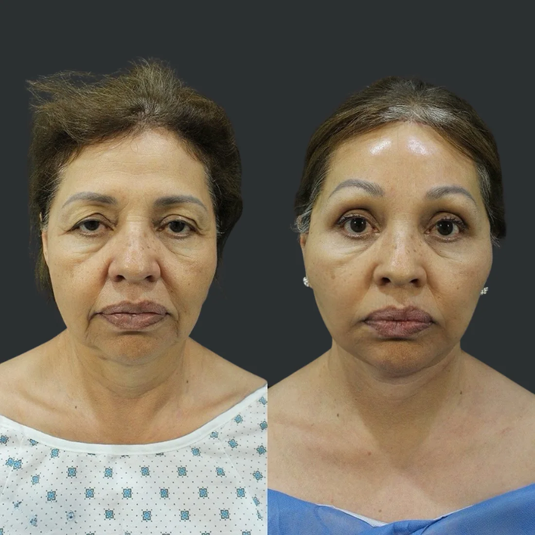 A patient before and after a deep plane face and neck lift by Dr. Quiroz
