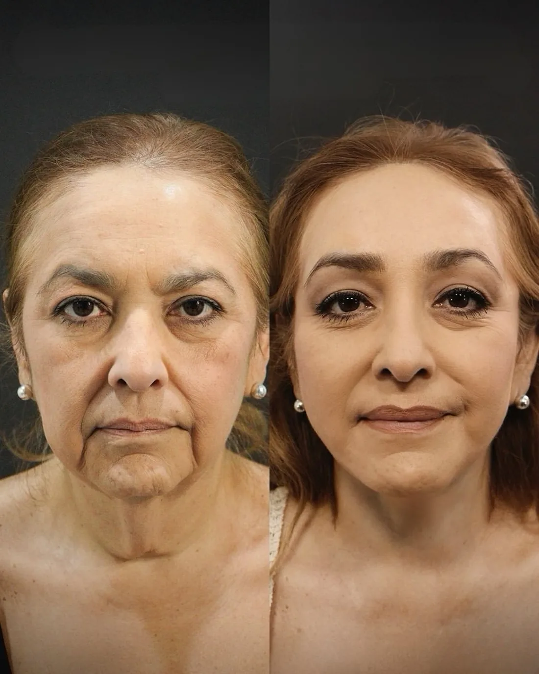 A patient before and after a deep plane facelift by Dr. Quiroz