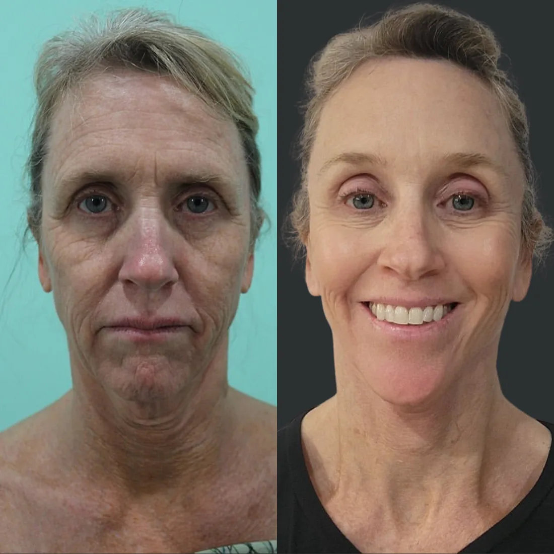 A patient before and after a deep plane facelift by Dr. Quiroz