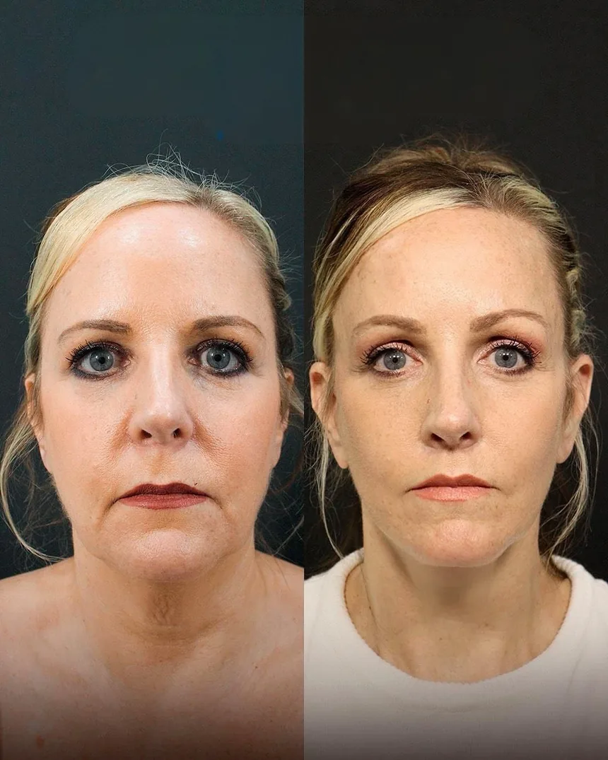 A patient before and after a Face, Neck and Brow Lift and Lip Enhancement and Fat Transfer to Lips by Dr. Quiroz in Tijuana. Individual results vary.