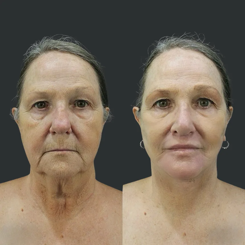 A patient before and after a Face, Neck, Rhinoplasty, Fat Transfer to Lips and Lip Lift and Dermabrasion by Dr. Quiroz in Tijuana. Individual results vary.