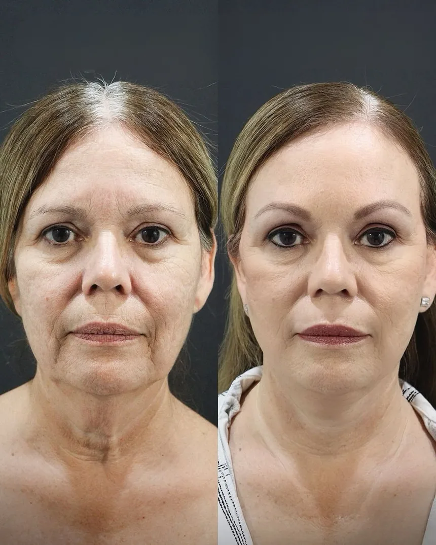 A patient before and after a Face and Neck Lift and Upper Lip Dermabrasion by Dr. Quiroz in Tijuana. Individual results vary.