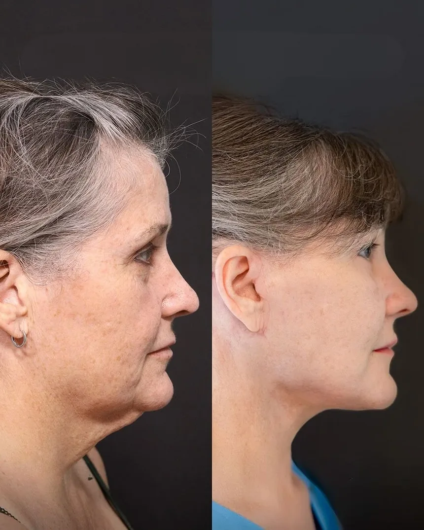 A patient before and after a Face and Neck Lift and Lower Eyelid Surgery by Dr. Quiroz in Tijuana. Individual results vary.