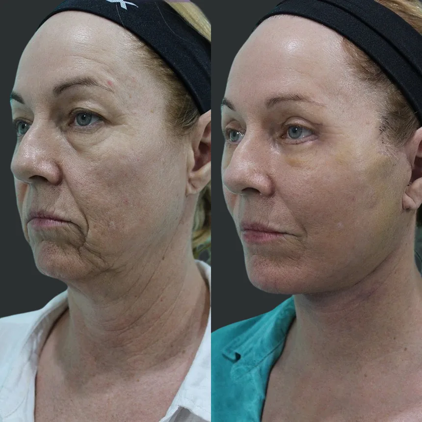 A patient before and after a Face and Neck Lift by Dr. Quiroz in Tijuana. Individual results vary.