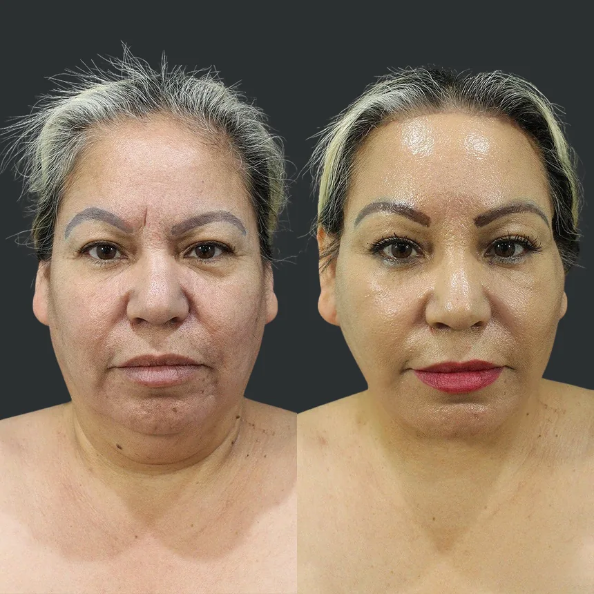 A patient before and after a Face and Neck Lift and Brow Lift by Dr. Quiroz in Tijuana. Individual results vary.