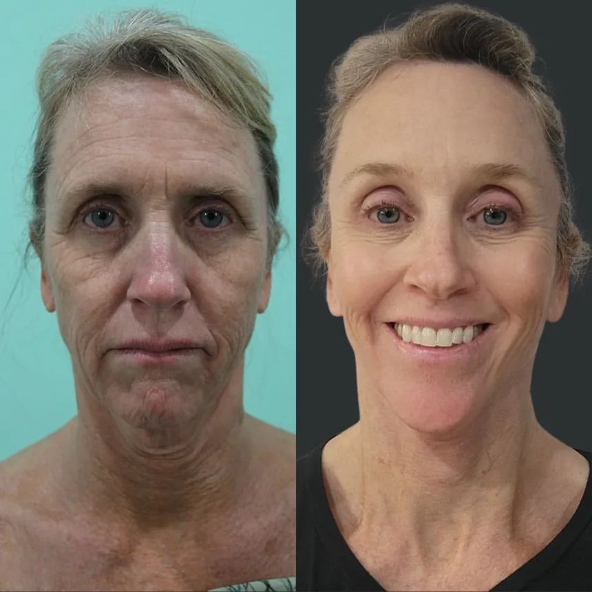 A patient before and after a Face and Neck Lift and Brow Lift by Dr. Quiroz in Tijuana. Individual results vary.