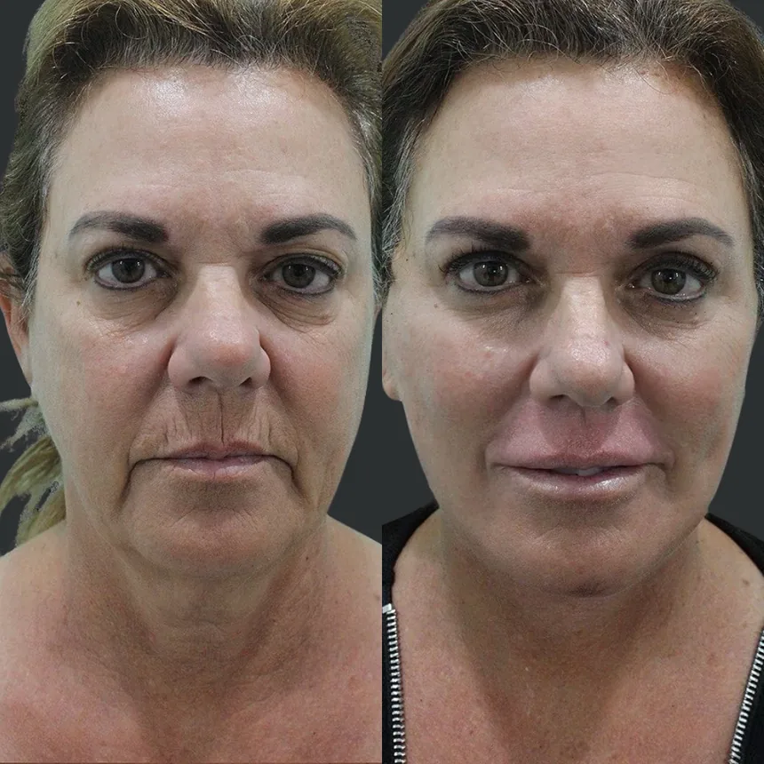 A patient before and after a Face and Neck Lift, Fat Transfer To Lips and Dermabrasion by Dr. Quiroz in Tijuana. Individual results vary.