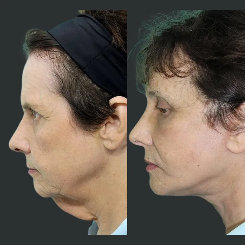 A patient before and after a Face and Neck Lift by Dr. Quiroz in Tijuana. Individual results vary.