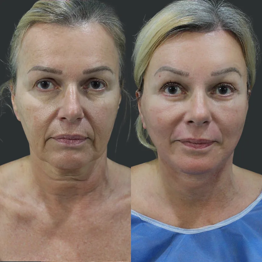 A patient before and after a Face, Neck and Brow Lift and Lower Eyelid Surgery and Dermabrasion by Dr. Quiroz in Tijuana. Individual results vary.
