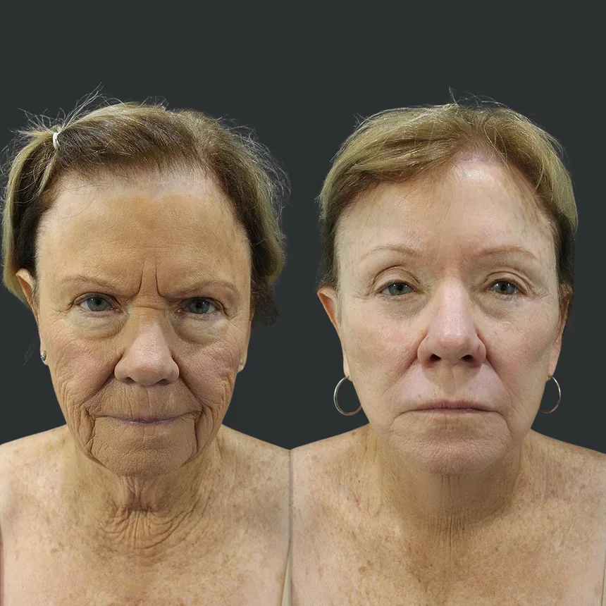 A patient before and after a Face, Neck and Brow Lift, Lower Eyelid and Fat Transfer to lips and Dermabrasion by Dr. Quiroz in Tijuana. Individual results vary.