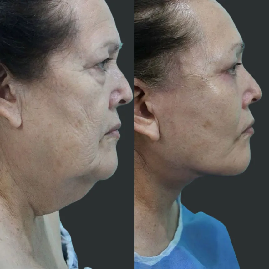 A patient before and after a Face, Neck Lift and Lower Eyelid Surgery by Dr. Quiroz in Tijuana. Individual results vary.