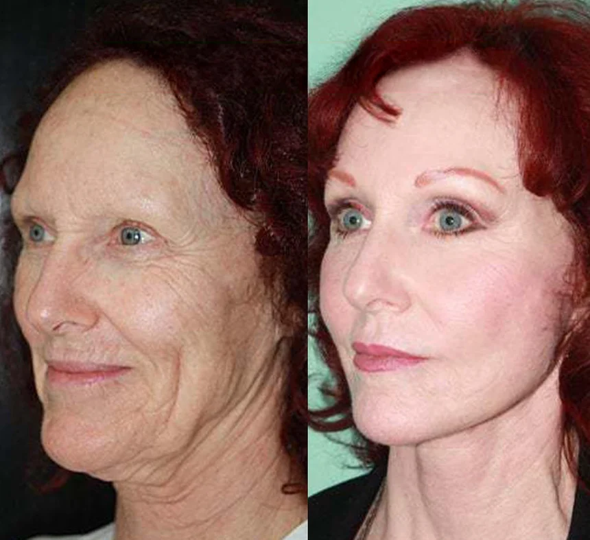 Before and after a deep plane face and neck lift by Dr. Quiroz, from the practice archive. Individual results vary.