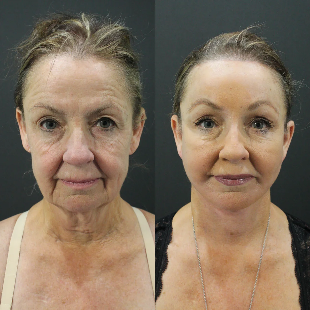 A patient before and after a Face, Neck and Brow Lift by Dr. Quiroz in Tijuana. Individual results vary.