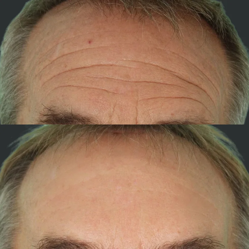 A patient before and after a Brow Lift by Dr. Quiroz in Tijuana. Individual results vary.