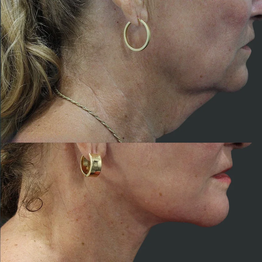 A patient before and after a Neck Lift by Dr. Quiroz in Tijuana. Individual results vary.