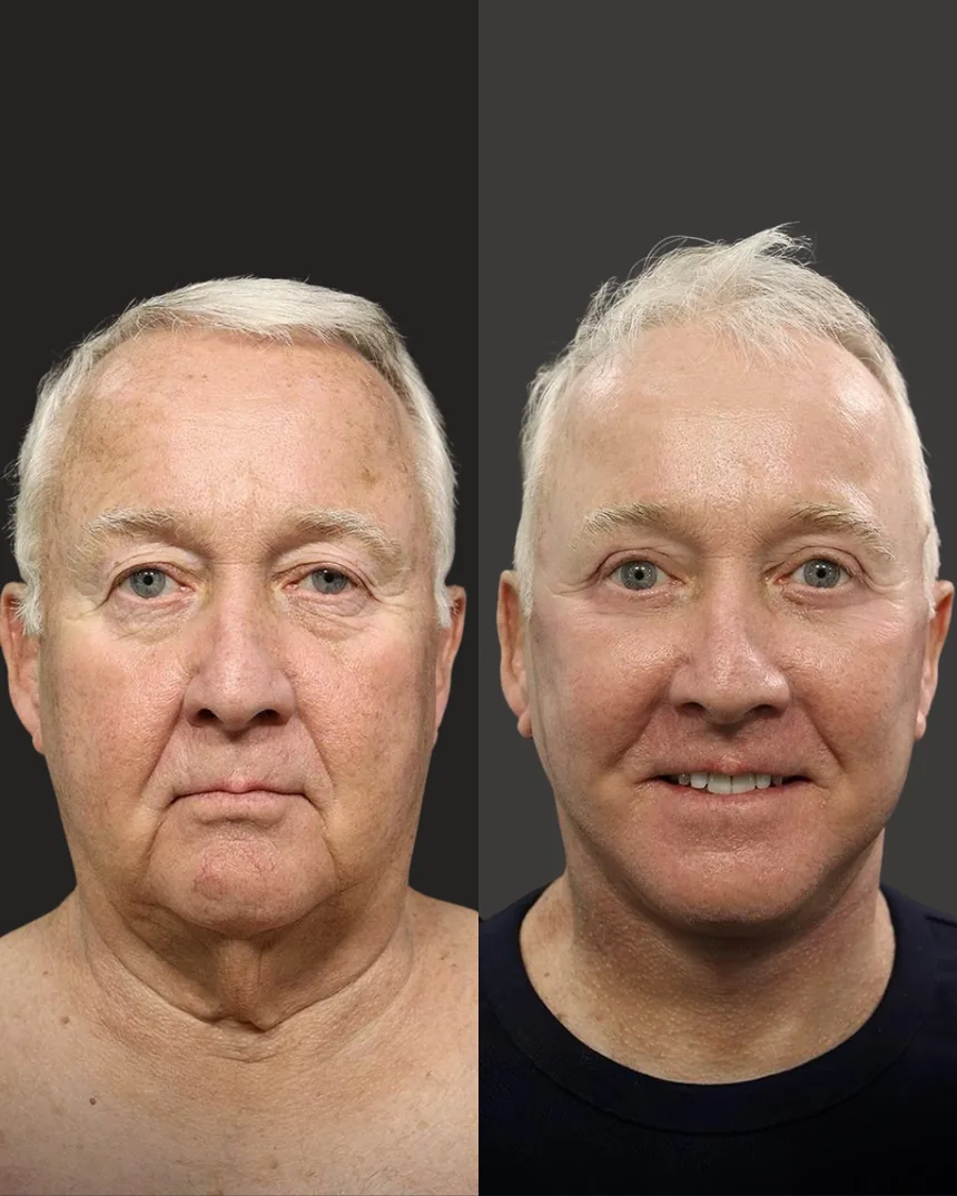 A patient before and after a Face and Neck Lift, Eyelid Surgery and CO2 Laser by Dr. Quiroz in Tijuana. Individual results vary.