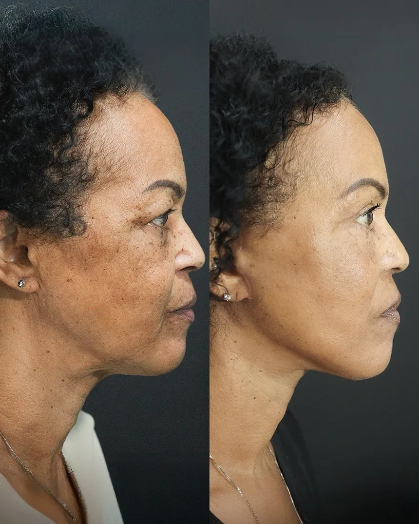 A patient before and after a face and neck lift + upper eyelid surgery by Dr. Quiroz. Individual results vary.
