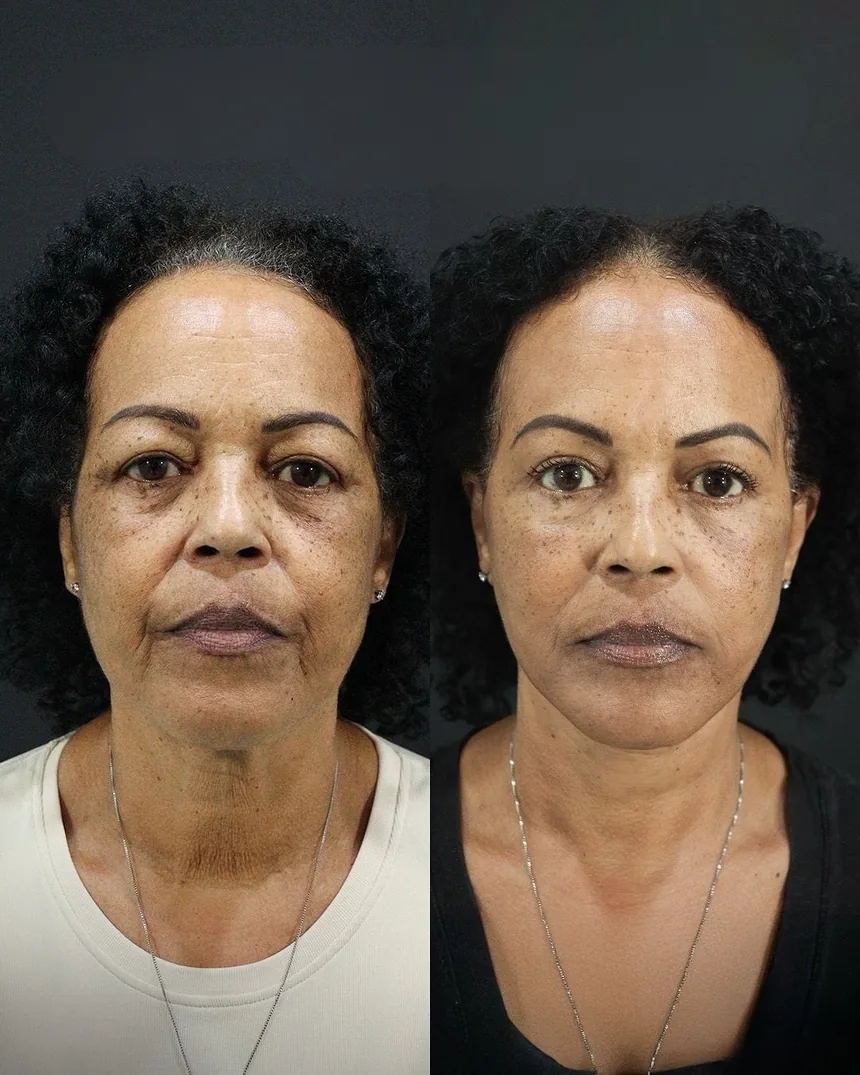 A patient before and after a Face and Neck Lift and Upper Eyelid Surgery by Dr. Quiroz in Tijuana. Individual results vary.