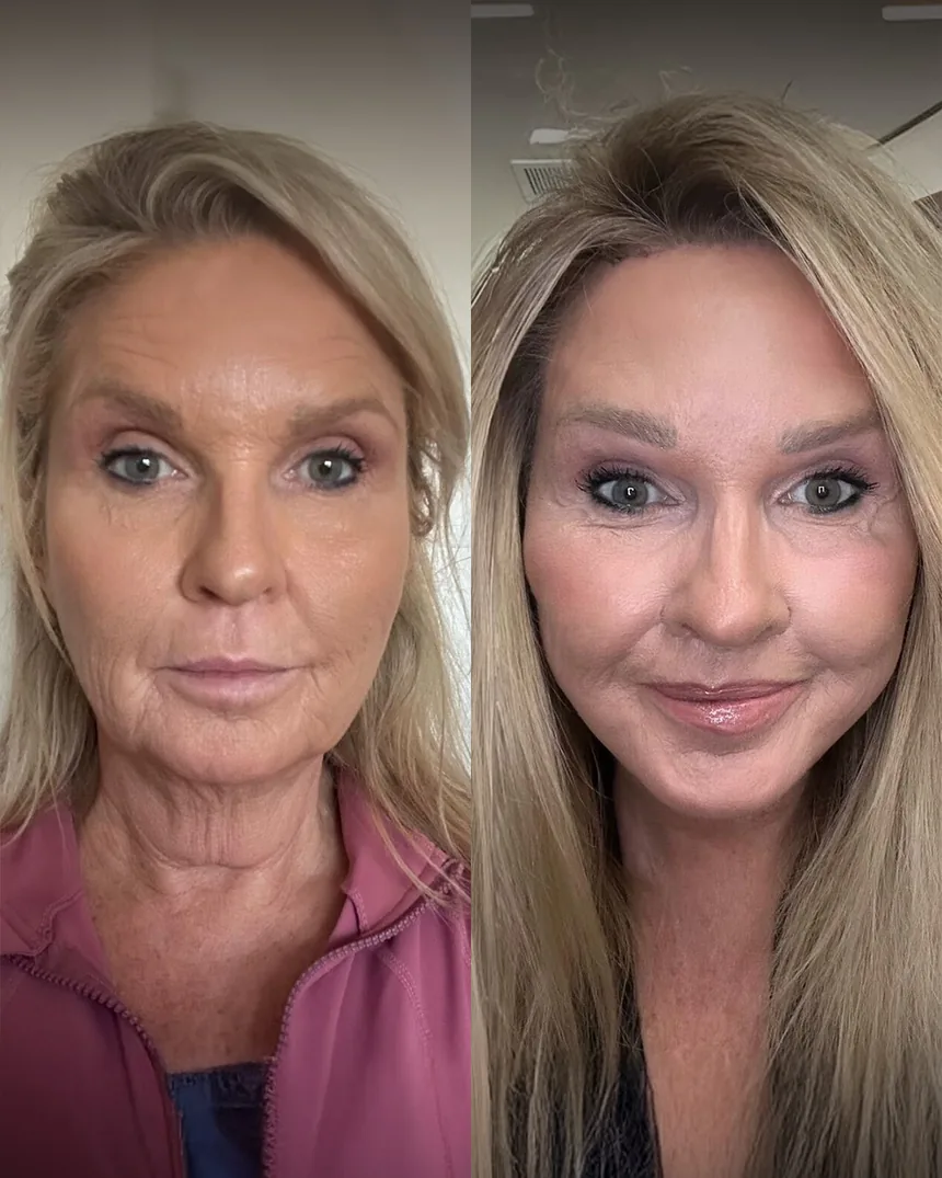 A patient before and after a Face, Neck and Brow Lift and CO2 Laser by Dr. Quiroz in Tijuana. Individual results vary.