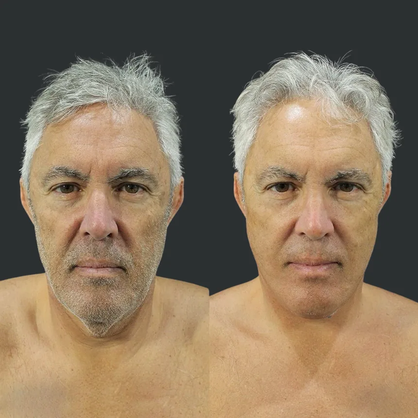 A patient before and after a Face and Neck Lift by Dr. Quiroz in Tijuana. Individual results vary.