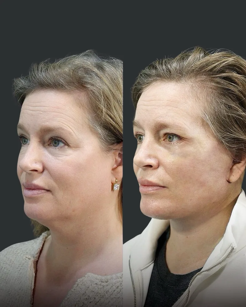 A patient before and after a Face and Neck Lift and Lower Eyelid Surgery by Dr. Quiroz in Tijuana. Individual results vary.