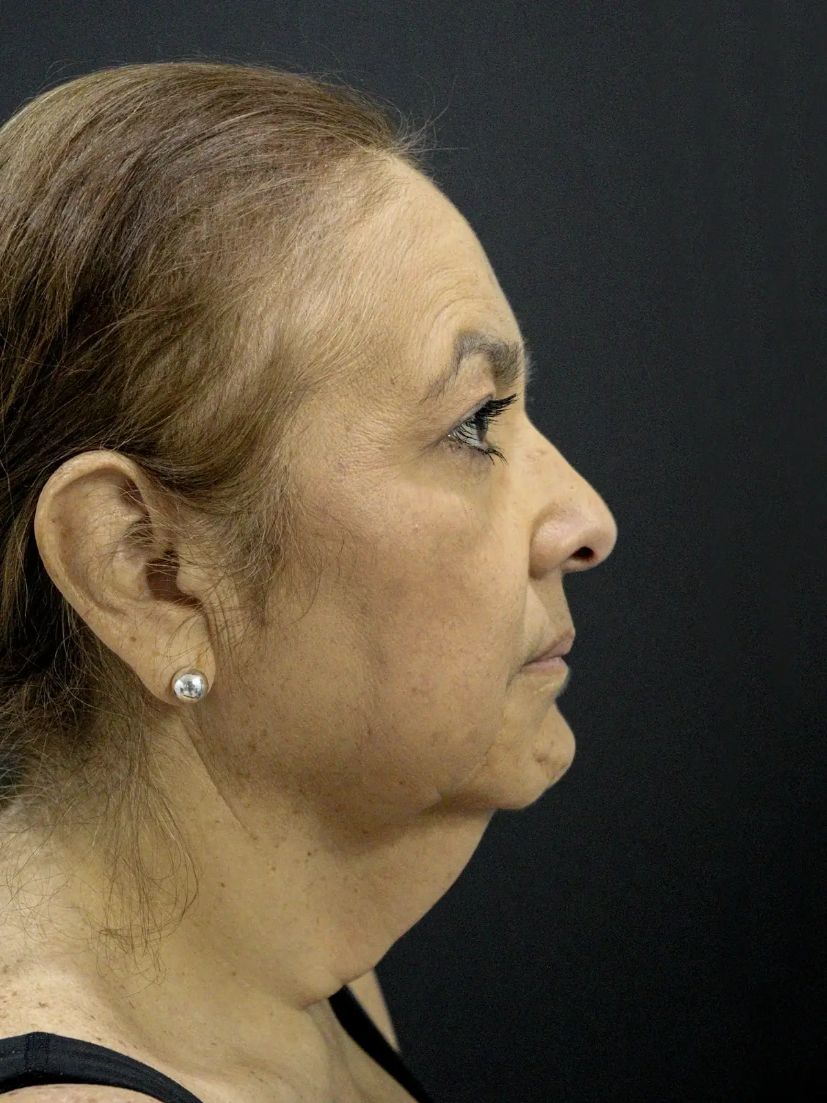 A patient's jawline and neck before a deep plane face and neck lift
