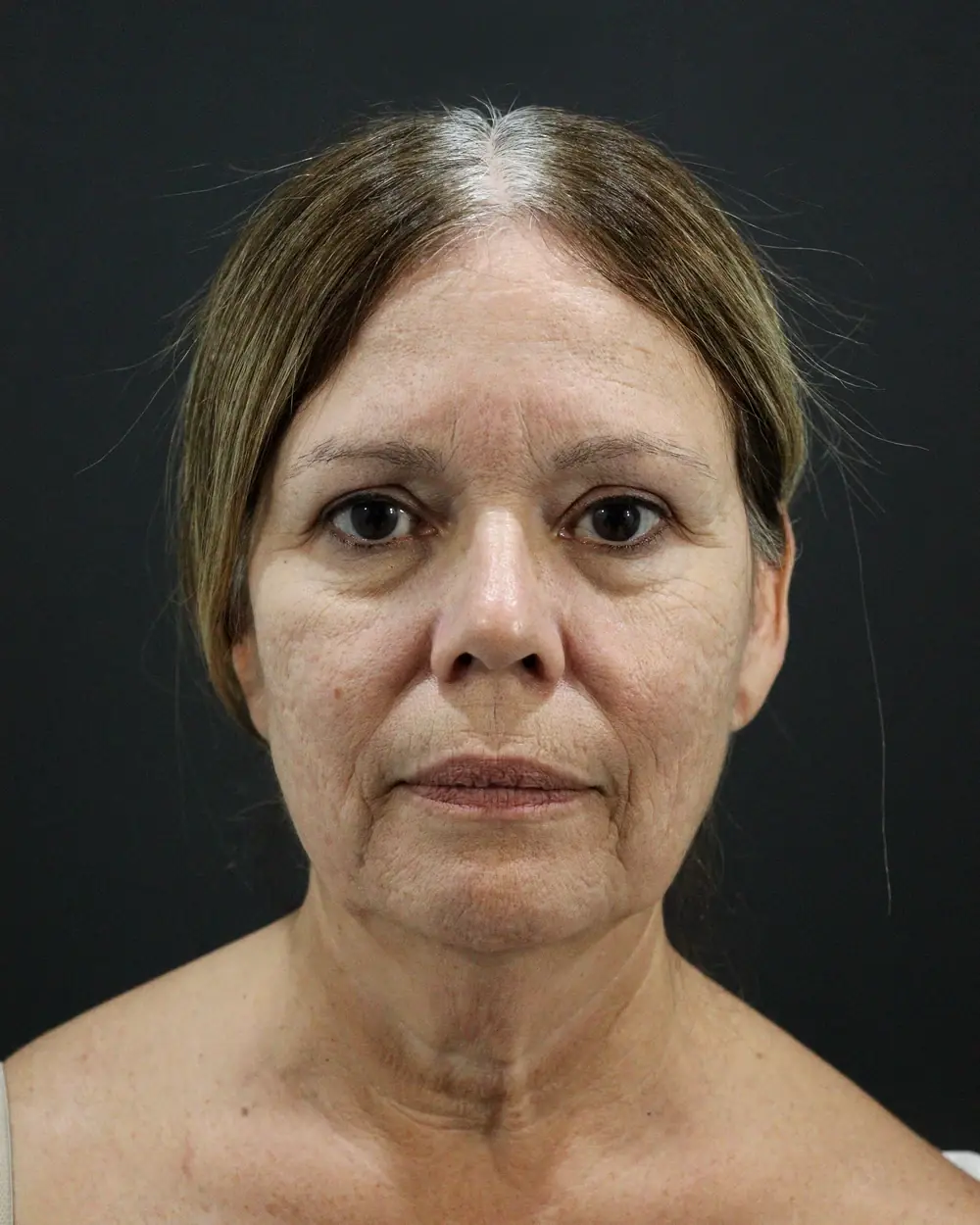 A face before a carefully planned deep plane lift
