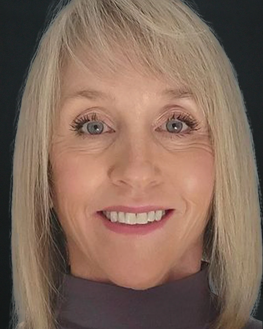 The same face after: the jawline and neck repositioned