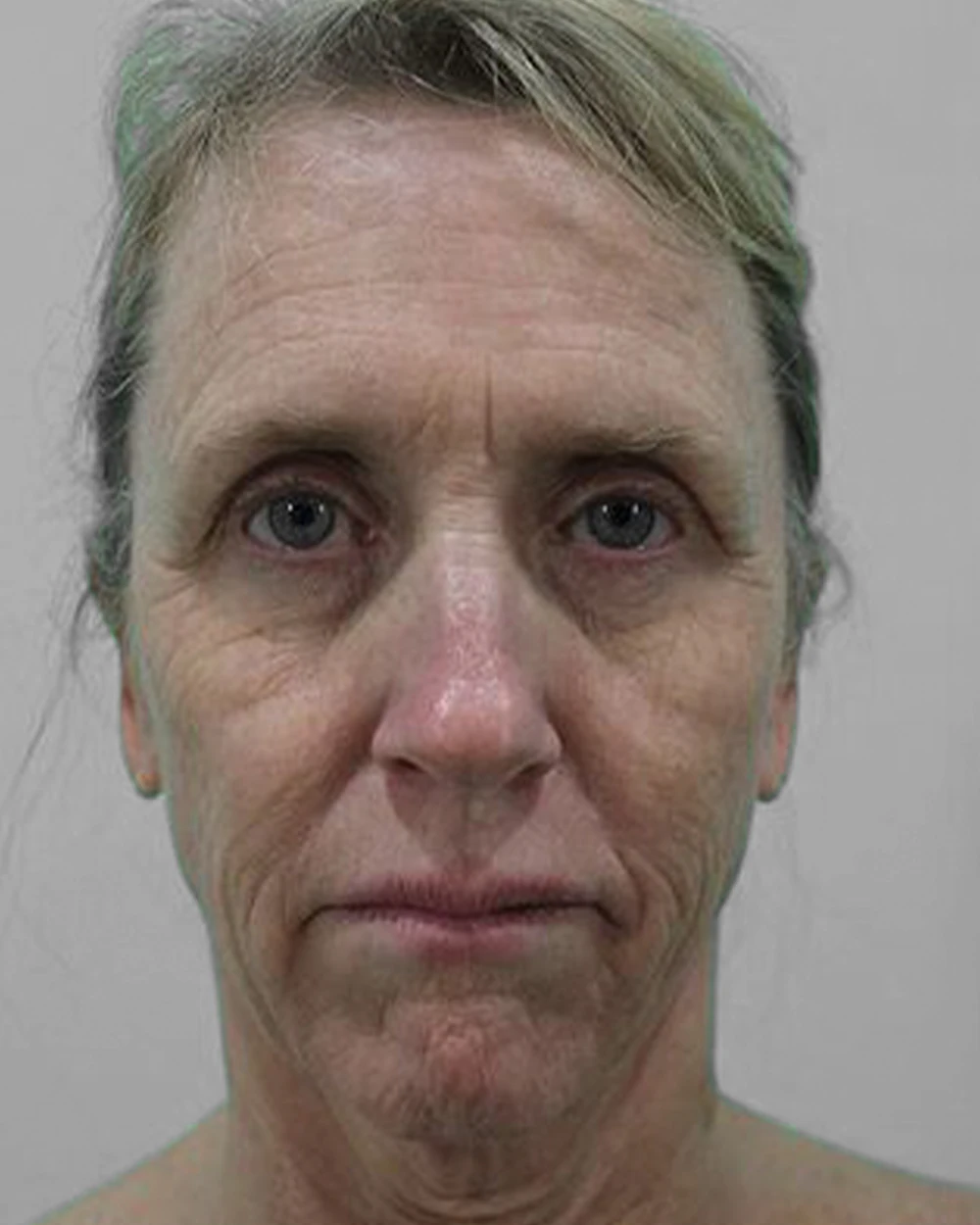A face before a deep plane facelift