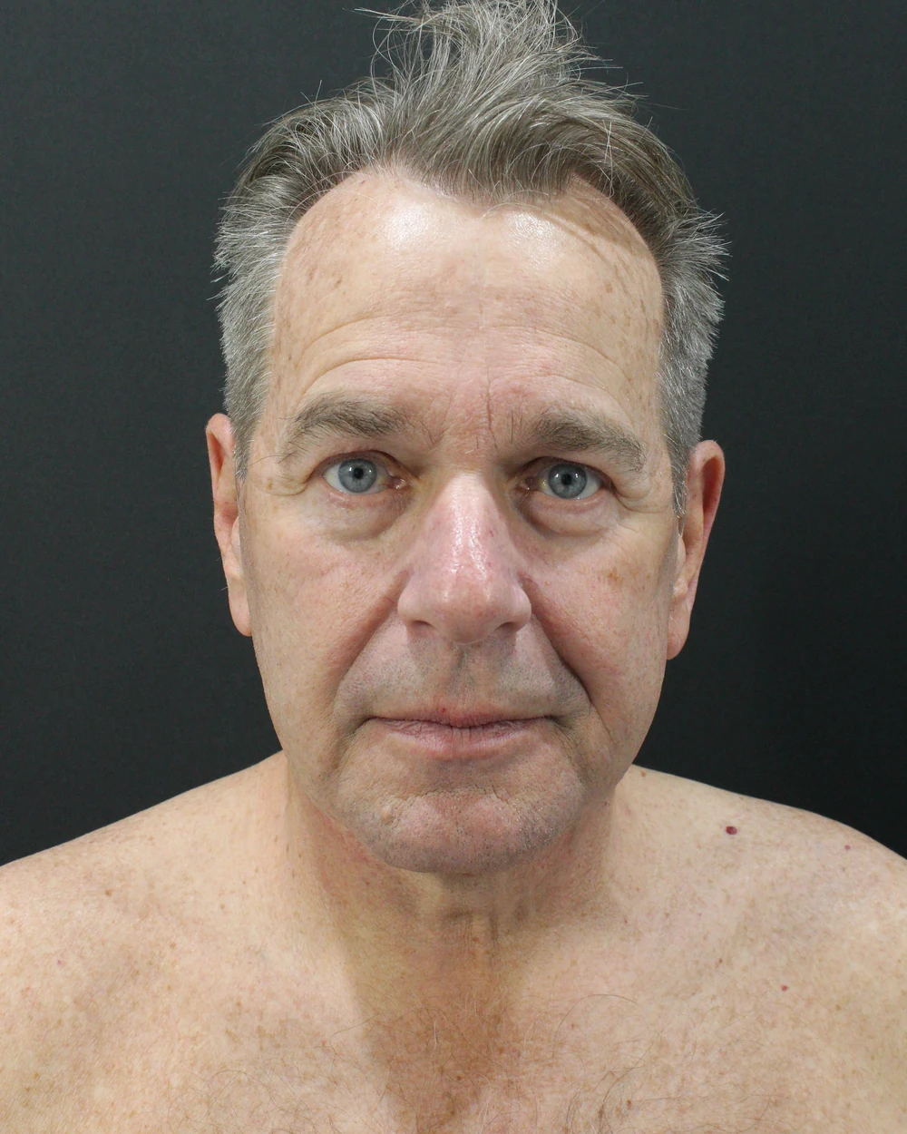 The same jawline after a lift repositions the structure
