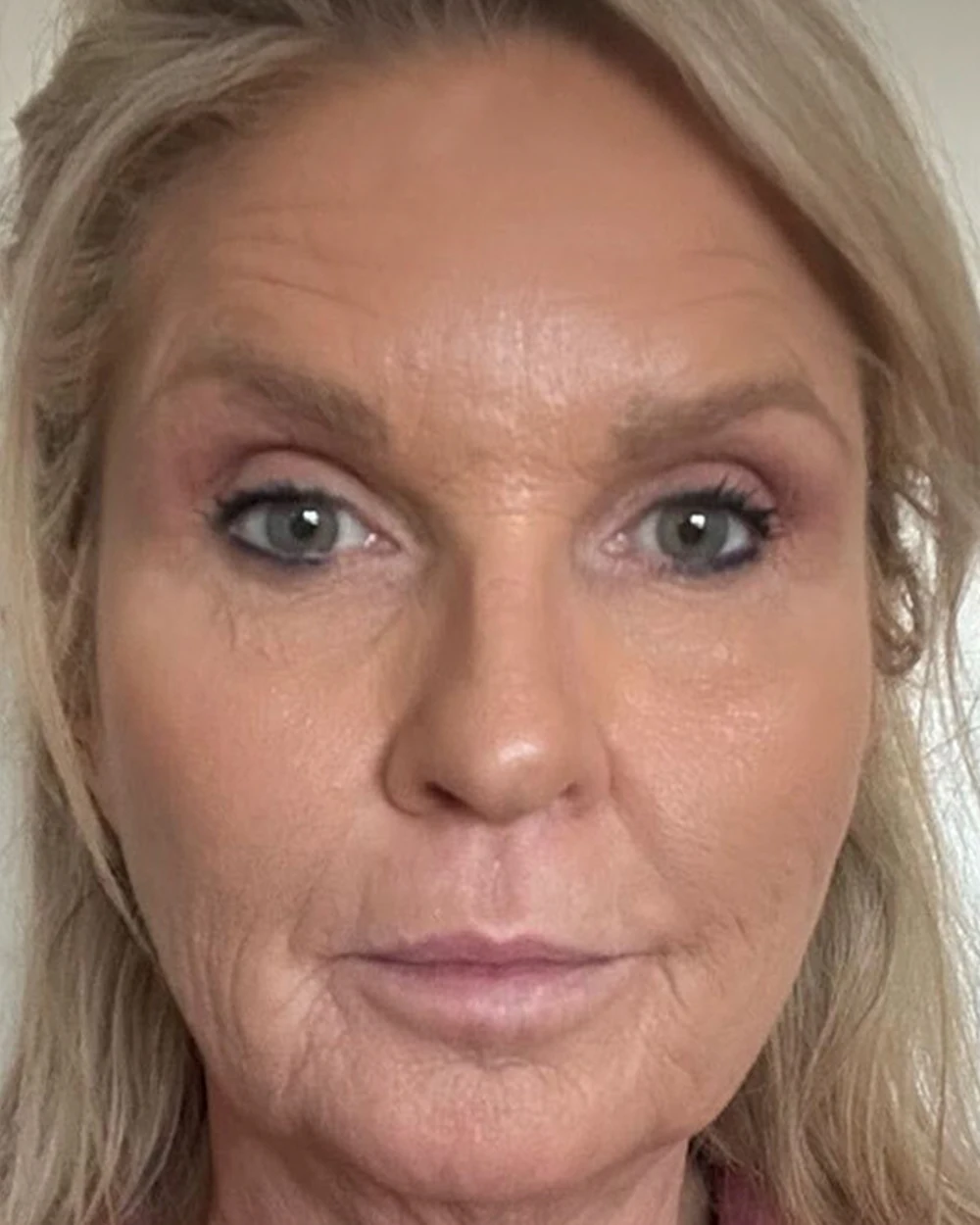 A patient before a deep plane facelift with Dr. Quiroz