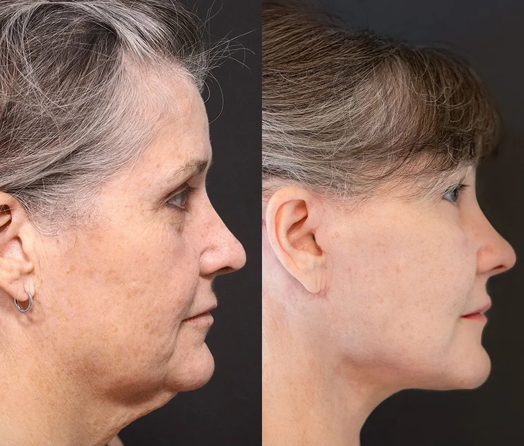 A patient before and after a Face and Neck Lift and Lower Eyelid Surgery by Dr. Quiroz in Tijuana. Individual results vary.