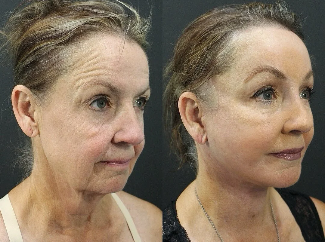 A patient before and after a Face, Neck and Brow Lift by Dr. Quiroz in Tijuana. Individual results vary.