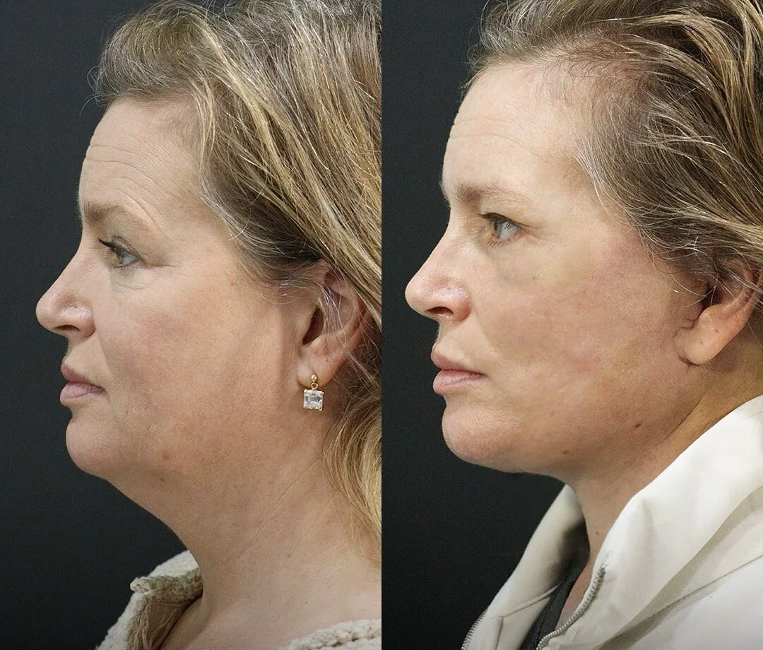 A patient before and after a Face and Neck Lift and Lower Eyelid Surgery by Dr. Quiroz in Tijuana. Individual results vary.
