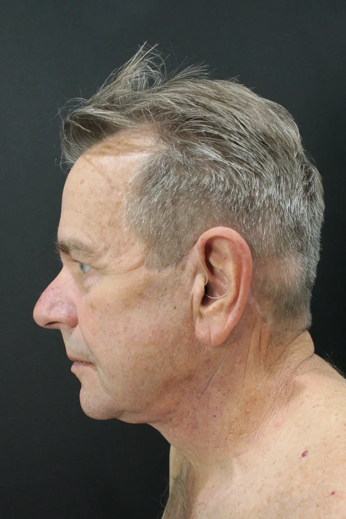 The same patient after a deep plane, which repositions the SMAS a short-scar 