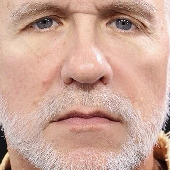 The same jawline after structural repositioning
