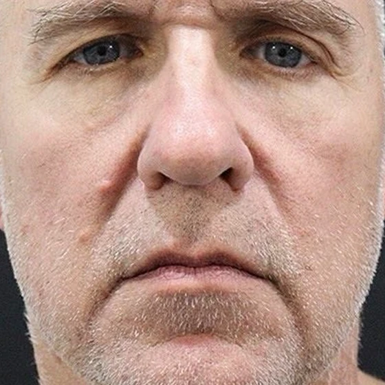 A jawline before surgery
